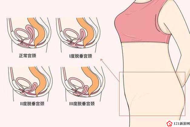 女性得阴挺病：病因、症状及治疗方法